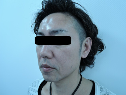 バッカルファット、銀座国際美容外科
