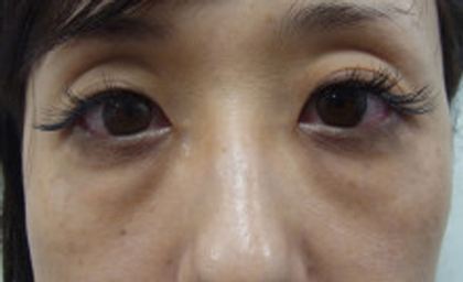 目の下のクマ、たるみ取り-銀座国際美容外科