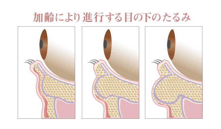 加齢により進行する目の下のたるみ-銀座国際美容外科