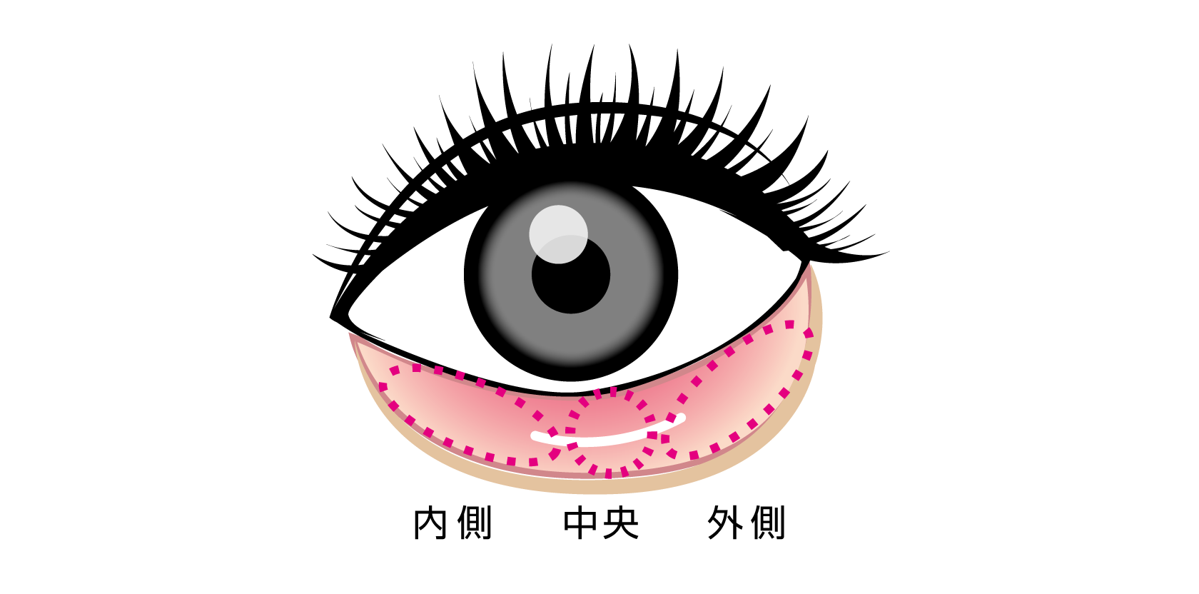 目の下のクマ,たるみ,脂肪-銀座国際美容外科