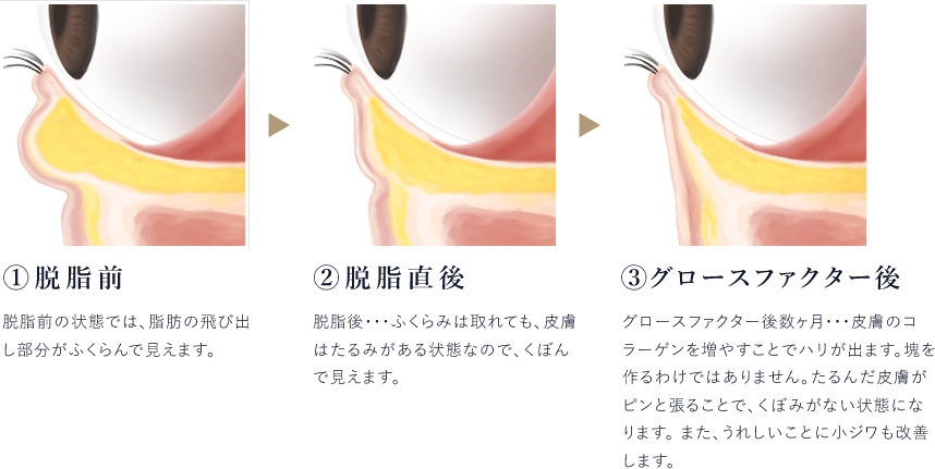 グロースファクターでくぼみが治る理由